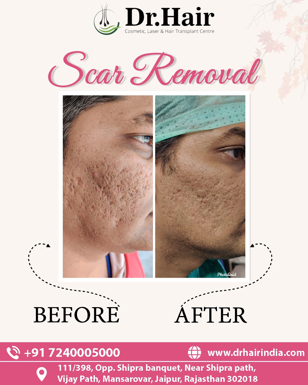 Hair Transplant Result 1