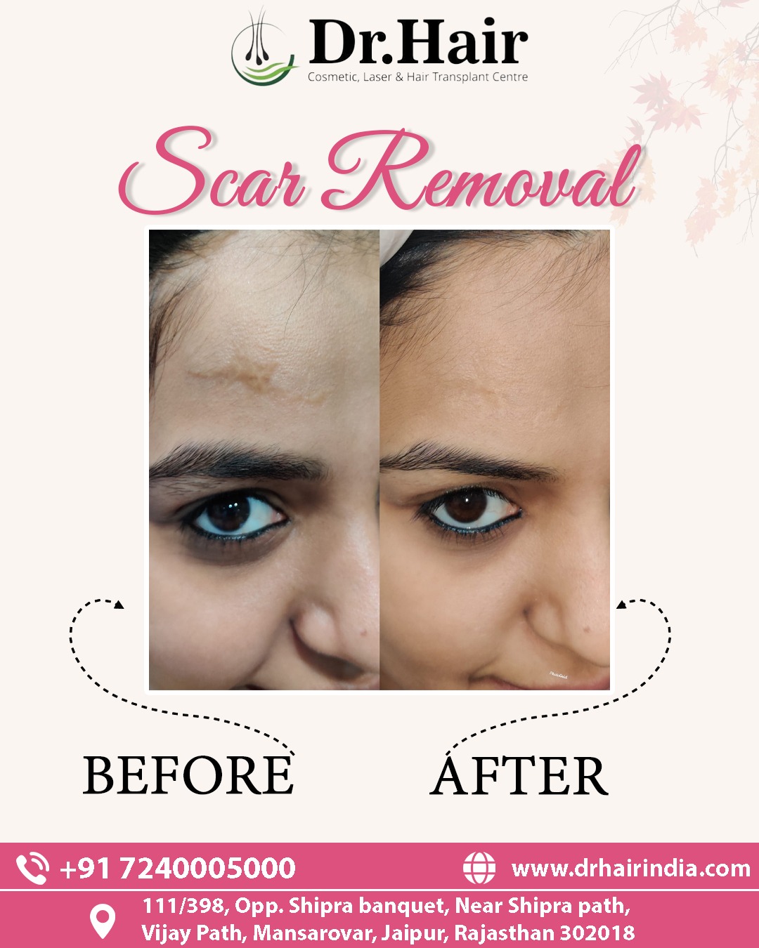 Hair Transplant Result 1