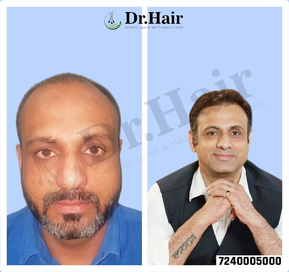Hair Transplant Result 1