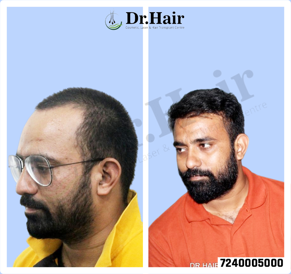 Hair Transplant Result 1