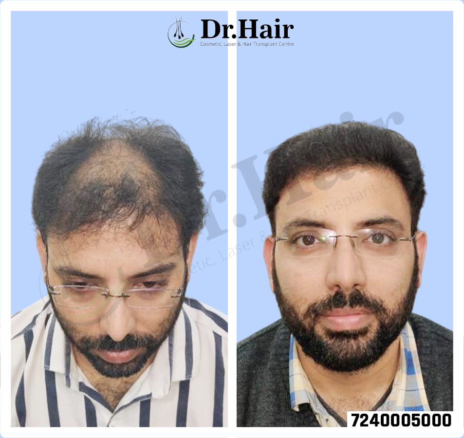 Hair Transplant Result 1