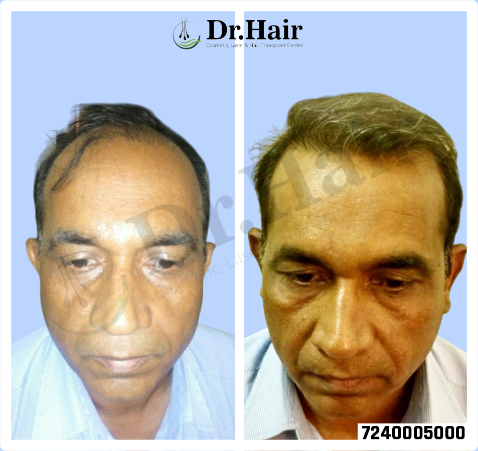 Hair Transplant Result 1