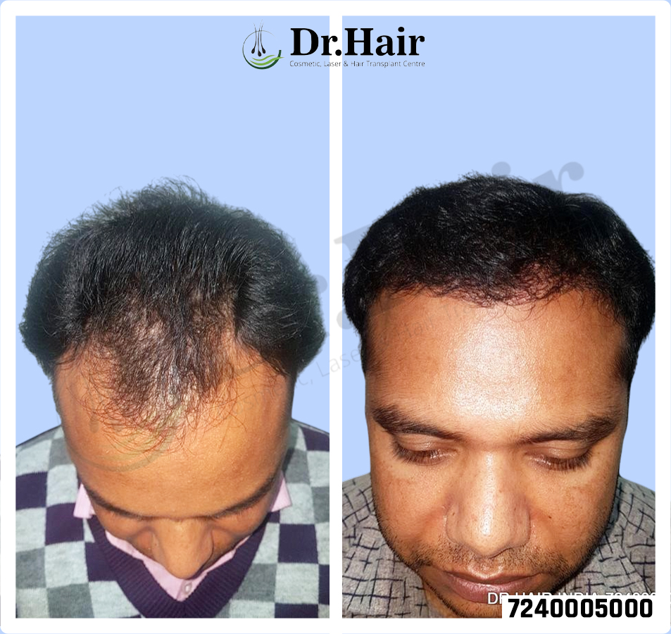 Hair Transplant Result 1