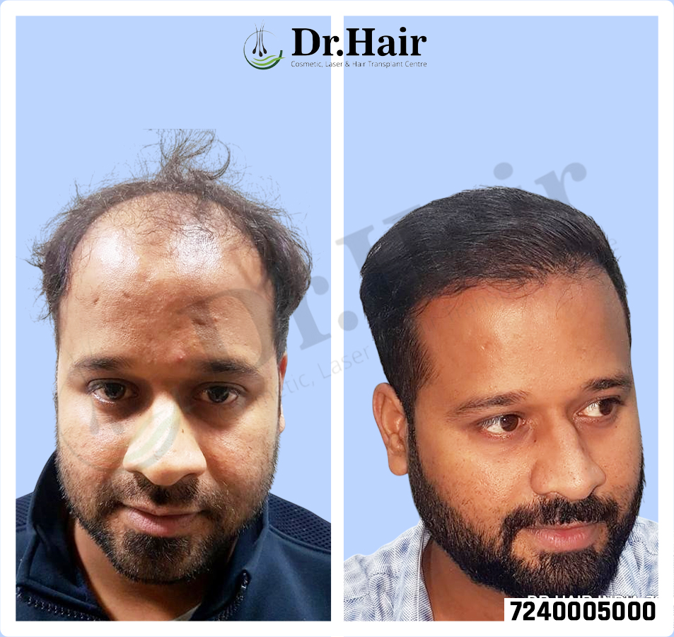 Hair Transplant Result 1