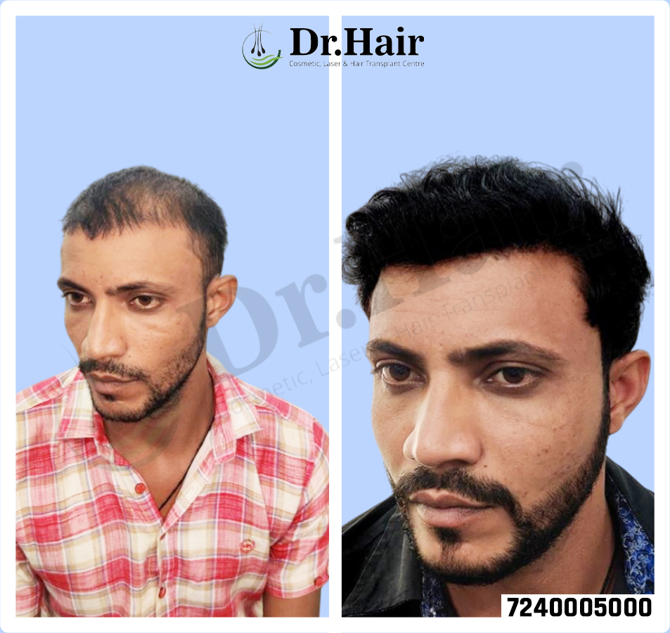 Hair Transplant Result 1