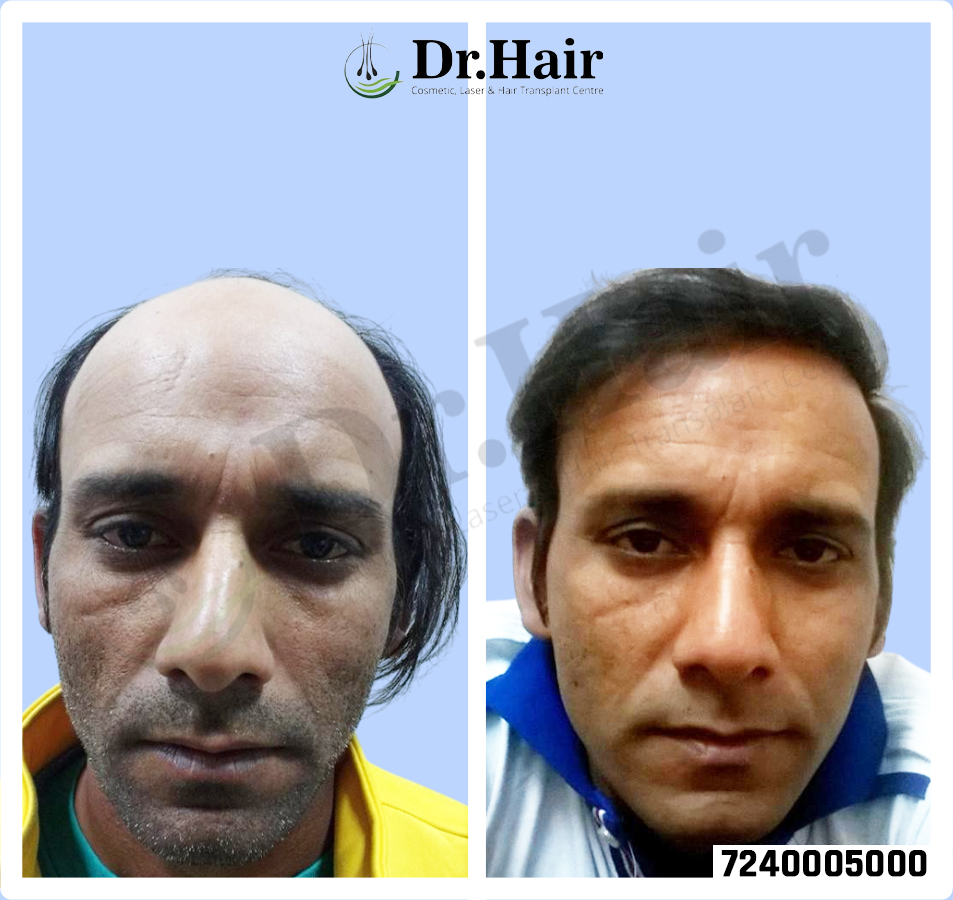 Hair Transplant Result 1