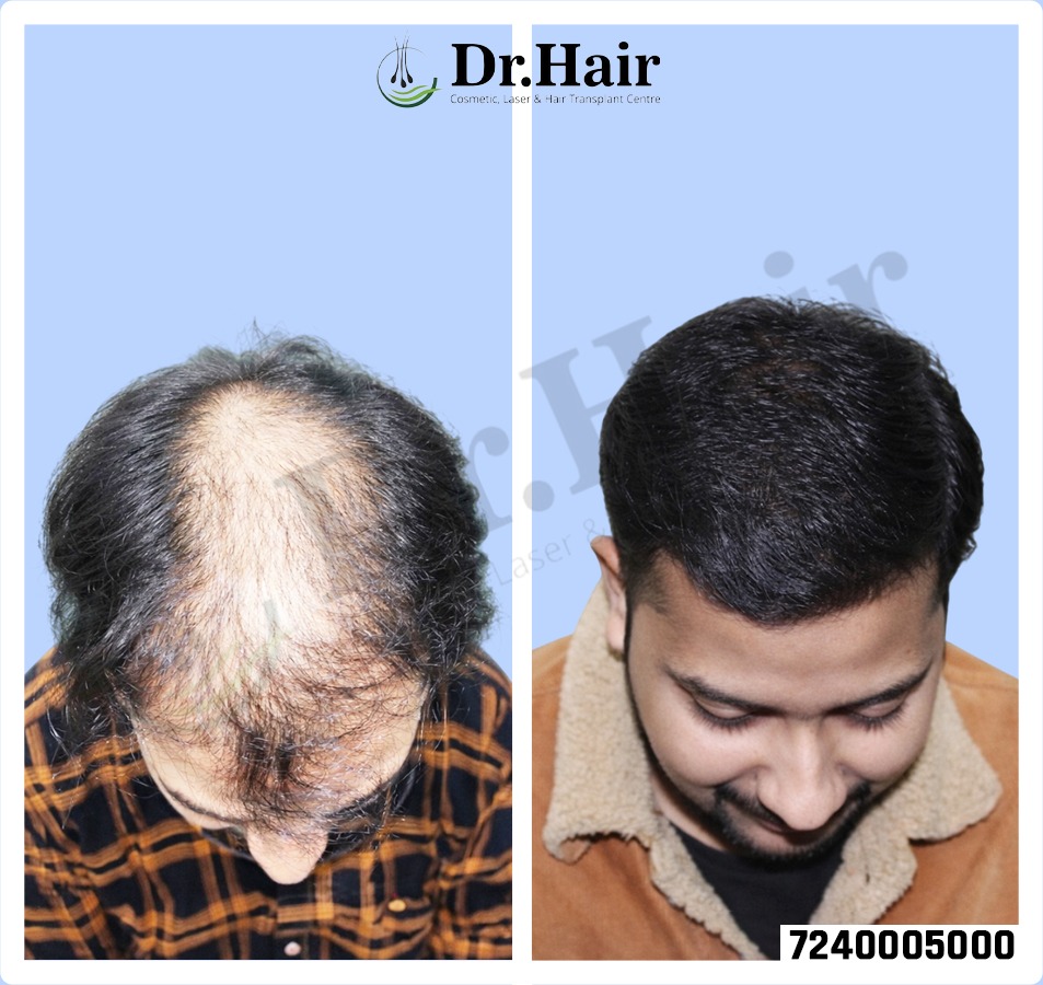 Hair Transplant Result 1