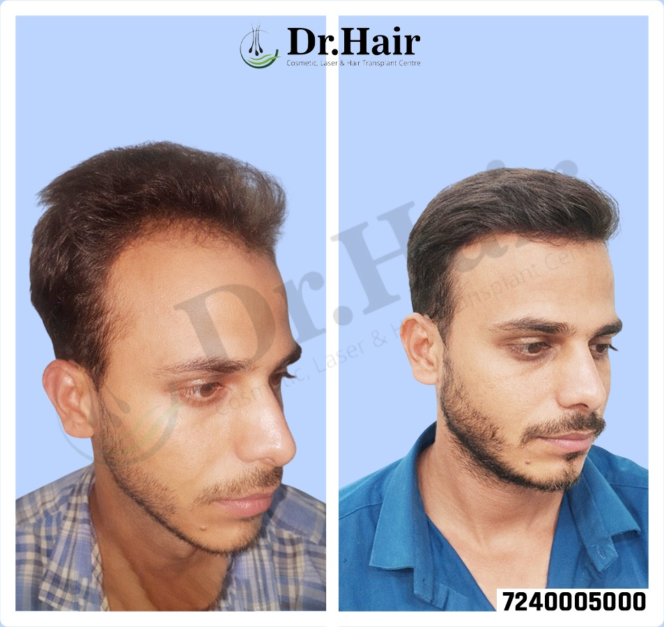 Hair Transplant Result 1