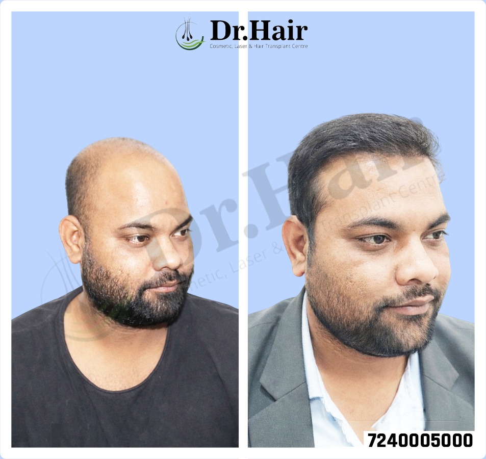 Hair Transplant Result 1