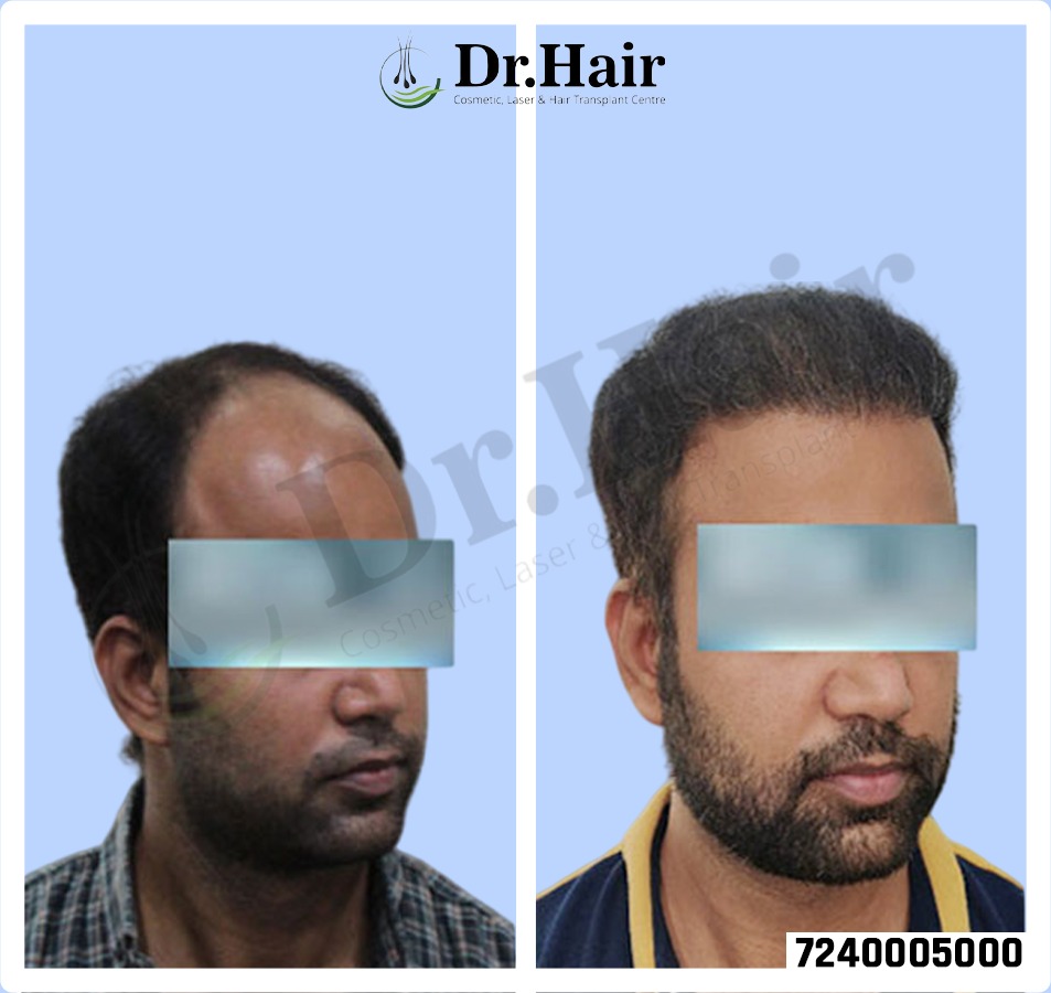 Hair Transplant Result 1
