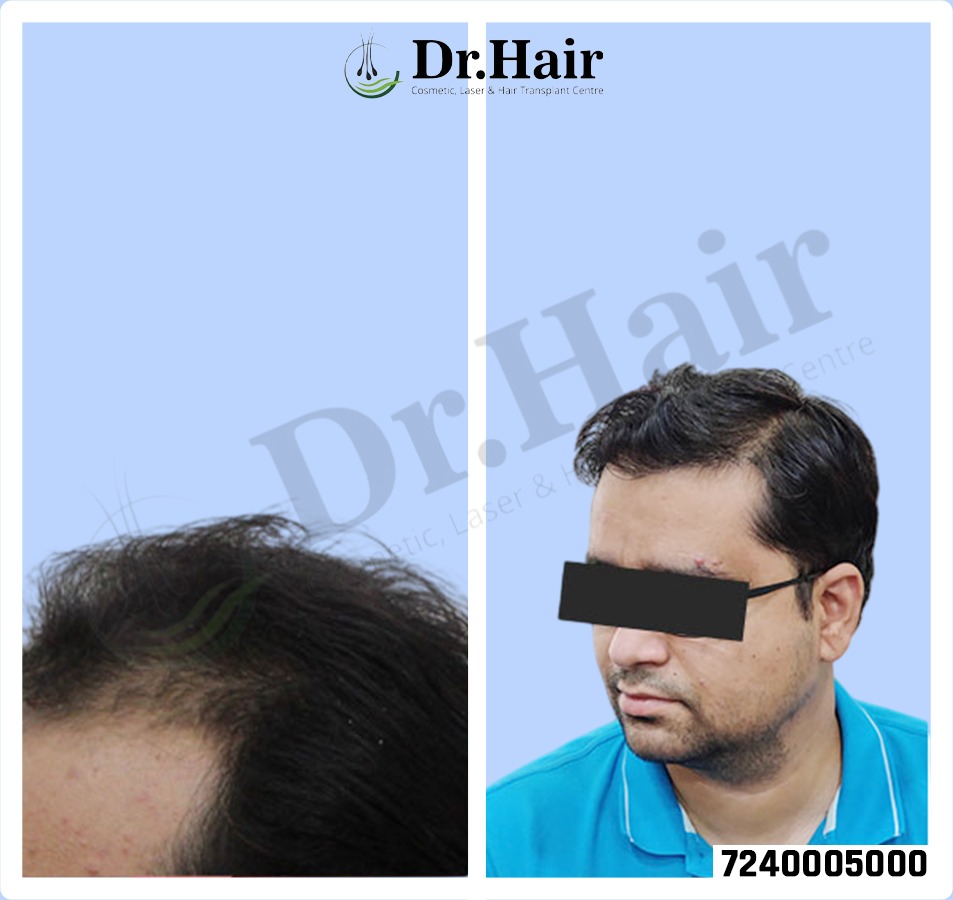 Hair Transplant Result 1