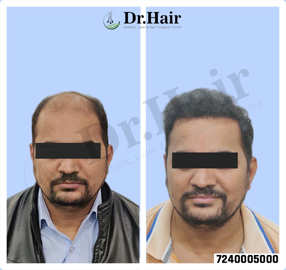 Hair Transplant Result 1