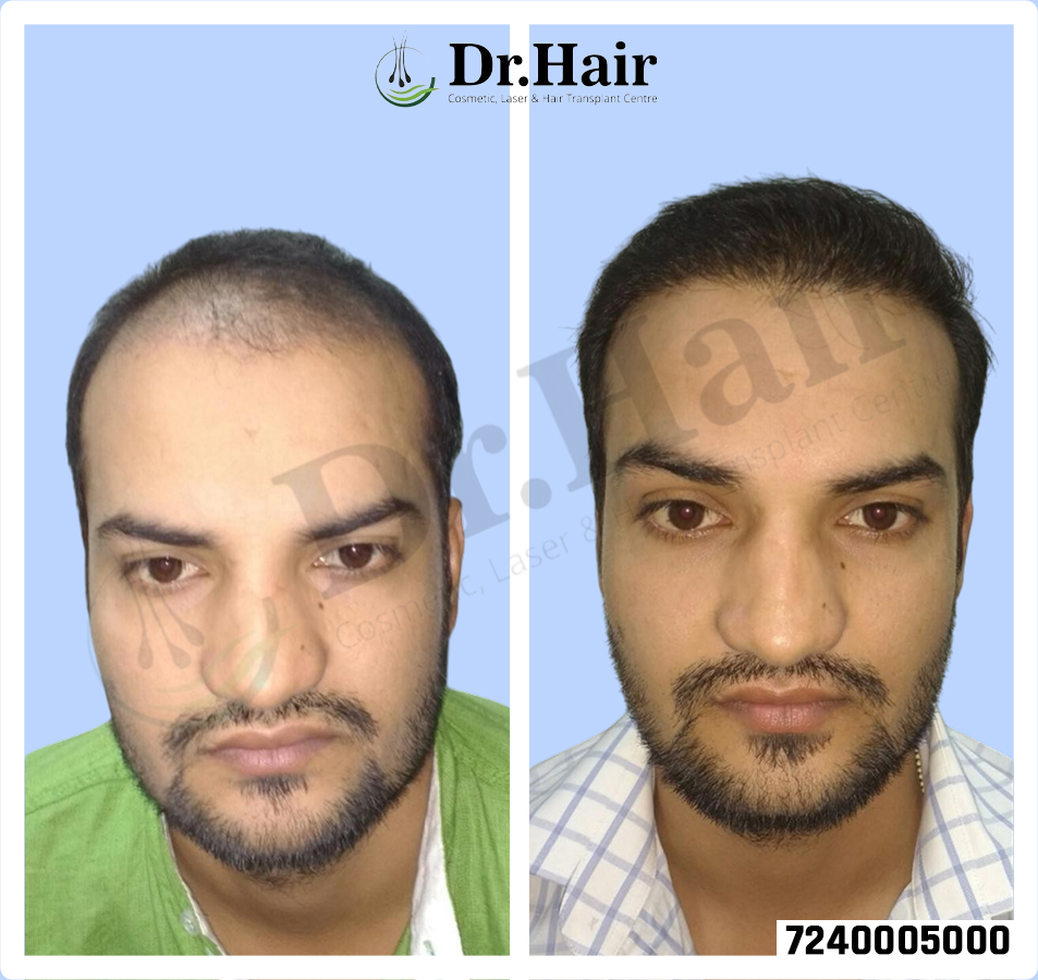 Hair Transplant Result 1