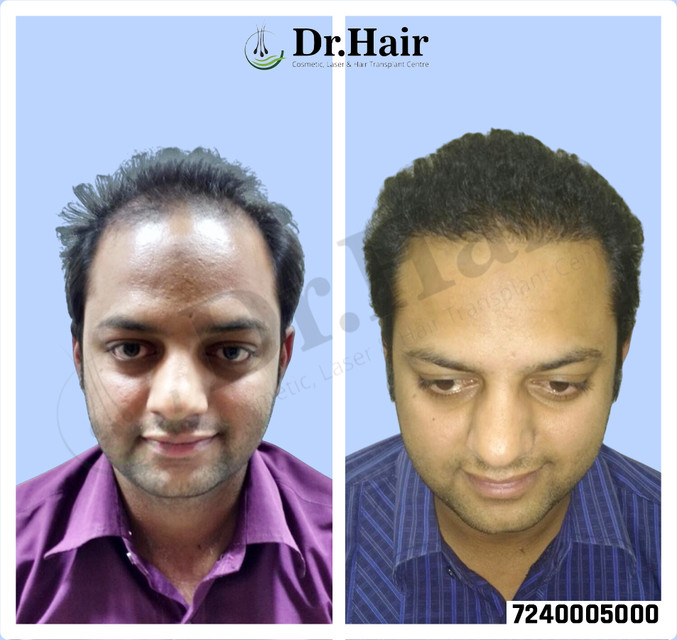Hair Transplant Result 1