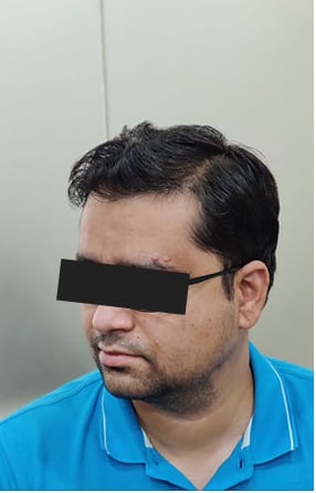 After — Hair transplant patient at DR HAIR® India, Jaipur, 3,500 grafts, FUE