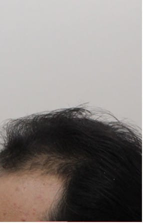 Before — Hair transplant patient at DR HAIR® India, Jaipur, 3,500 grafts, FUE