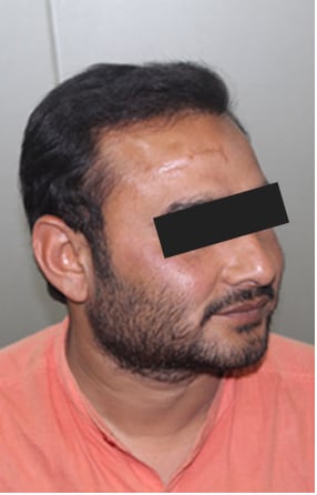 After — Hair transplant patient at DR HAIR® India, Jaipur, 3,200 grafts, FUE