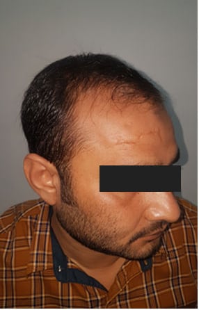 Before — Hair transplant patient at DR HAIR® India, Jaipur, 3,200 grafts, FUE