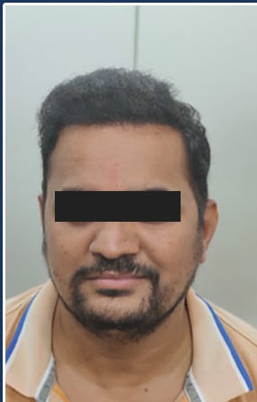 After — Hair transplant patient at DR HAIR® India, Jaipur, 3,000 grafts, FUE