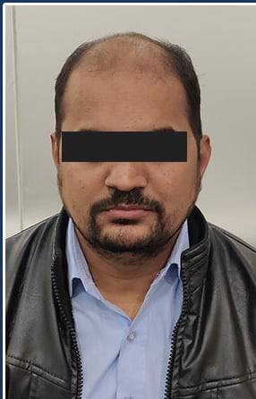 Before — Hair transplant patient at DR HAIR® India, Jaipur, 3,000 grafts, FUE
