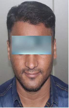 After — Hair transplant patient at DR HAIR® India, Jaipur, 3,500 grafts, FUE