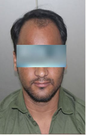 Before — Hair transplant patient at DR HAIR® India, Jaipur, 3,500 grafts, FUE