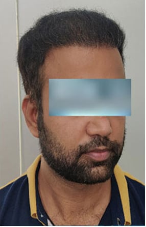 After — Hair transplant patient at DR HAIR® India, Jaipur, 3,500 grafts, FUE