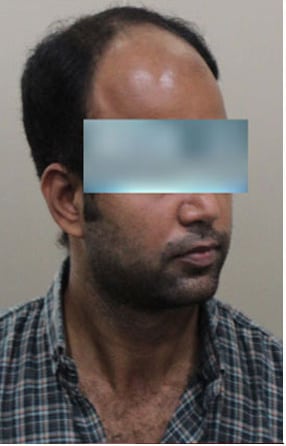 Before — Hair transplant patient at DR HAIR® India, Jaipur, 3,500 grafts, FUE
