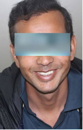After — Hair transplant patient at DR HAIR® India, Jaipur, 3,500 grafts, FUE