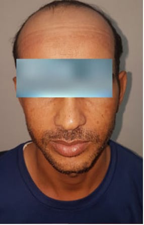 Before — Hair transplant patient at DR HAIR® India, Jaipur, 3,500 grafts, FUE