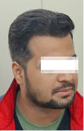 After — Hair transplant patient at DR HAIR® India, Jaipur, 3,500 grafts, FUE