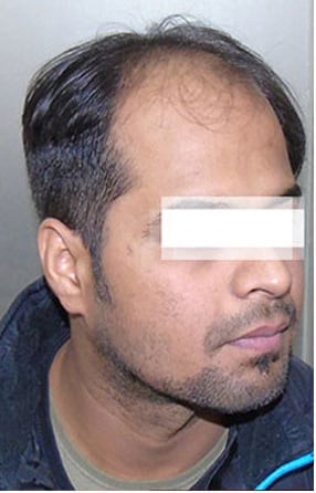 Before — Hair transplant patient at DR HAIR® India, Jaipur, 3,500 grafts, FUE