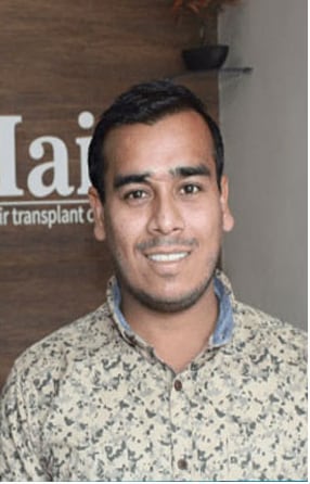After — Hair transplant patient at DR HAIR® India, Jaipur, 3,500 grafts, FUE