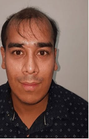 Before — Hair transplant patient at DR HAIR® India, Jaipur, 3,500 grafts, FUE