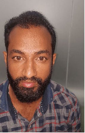Before — Hair transplant patient at DR HAIR® India, Jaipur, 3,500 grafts, FUE