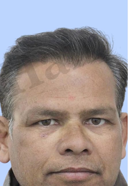 After — Hair transplant patient result 1 at DR HAIR® India, Jaipur