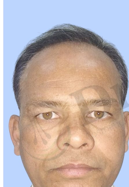 Before — Hair transplant patient result 1 at DR HAIR® India, Jaipur