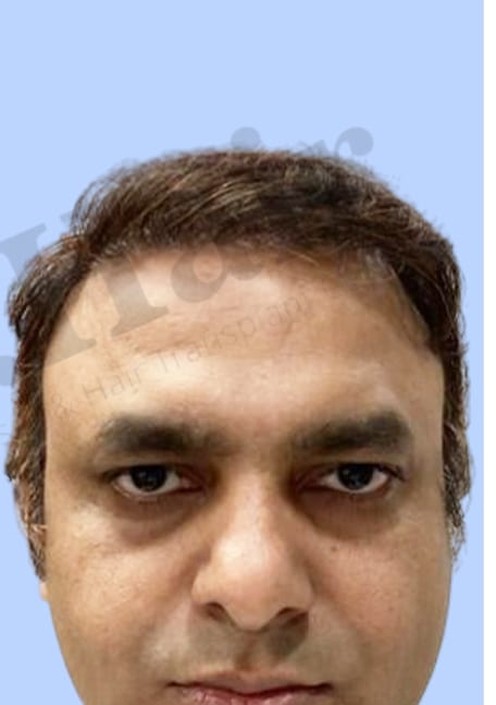 After — Hair transplant patient result 10 at DR HAIR® India, Jaipur