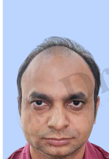 Before — Hair transplant patient result 10 at DR HAIR® India, Jaipur