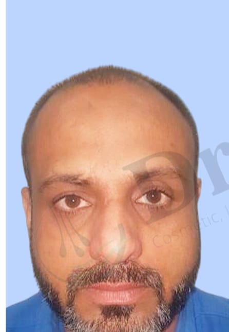 Before — Hair transplant patient result 11 at DR HAIR® India, Jaipur