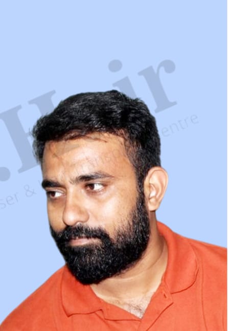 After — Hair transplant patient result 12 at DR HAIR® India, Jaipur