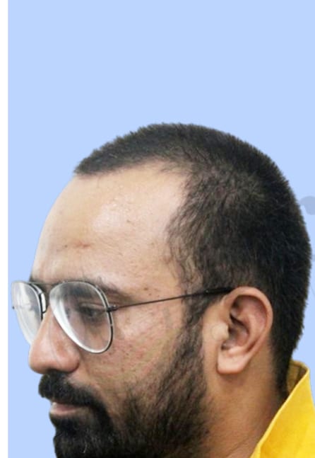 Before — Hair transplant patient result 12 at DR HAIR® India, Jaipur