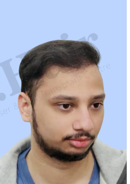 After — Hair transplant patient result 13 at DR HAIR® India, Jaipur