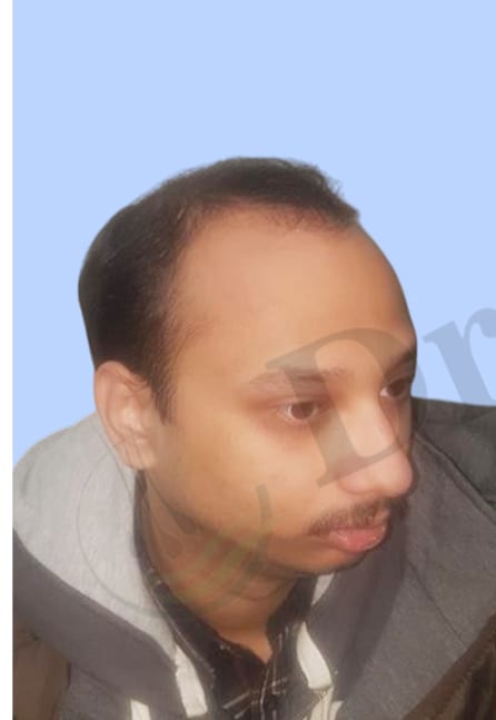 Before — Hair transplant patient result 13 at DR HAIR® India, Jaipur