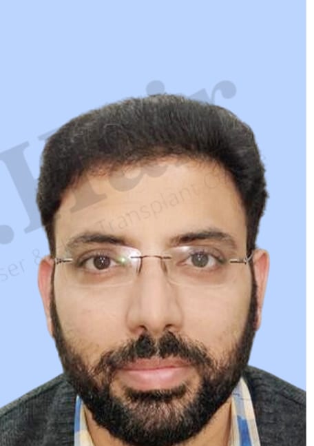 After — Hair transplant patient result 14 at DR HAIR® India, Jaipur