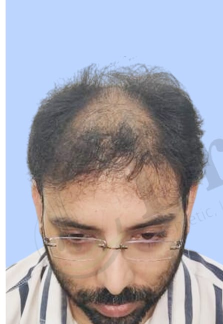 Before — Hair transplant patient result 14 at DR HAIR® India, Jaipur