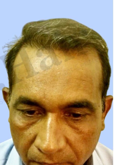 After — Hair transplant patient result 15 at DR HAIR® India, Jaipur