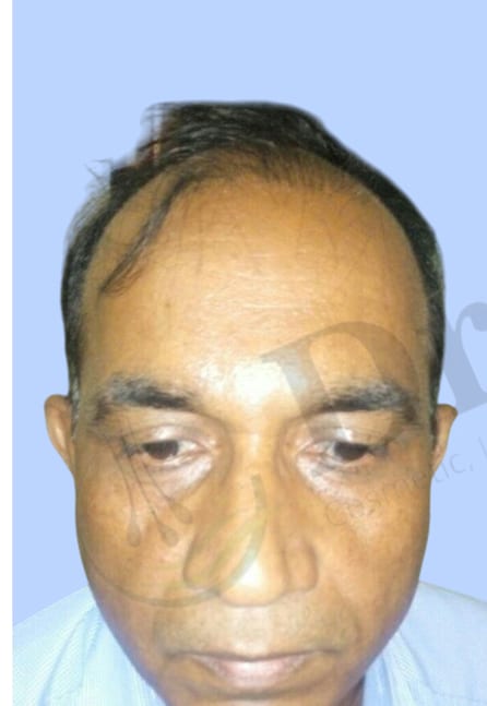 Before — Hair transplant patient result 15 at DR HAIR® India, Jaipur