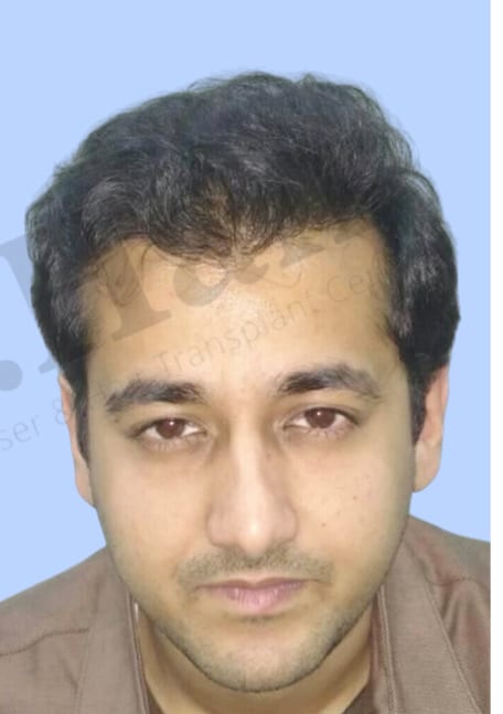 After — Hair transplant patient result 16 at DR HAIR® India, Jaipur