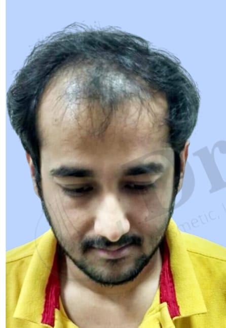 Before — Hair transplant patient result 16 at DR HAIR® India, Jaipur